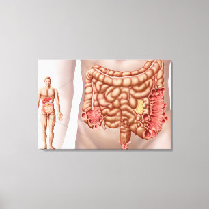 Diverticulitis In The Descending Colon Region Canvas Print