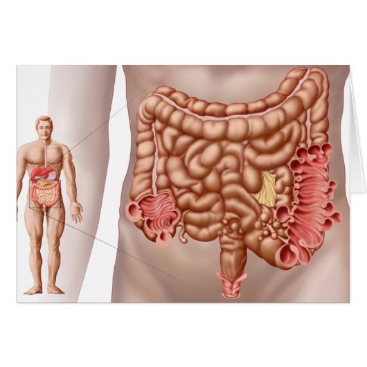 Diverticulitis In The Descending Colon Region Cards (Front Horizontal)