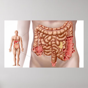 Diverticulitis In The Descending Colon Region Poster