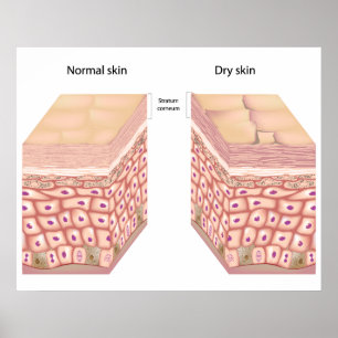 Dry skin Poster
