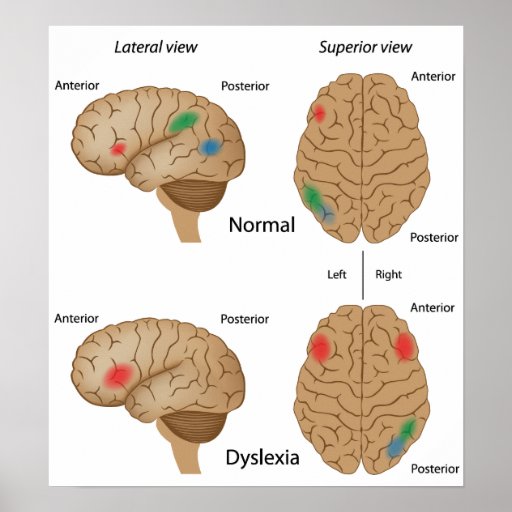 Dyslexia brain activity Poster | Zazzle