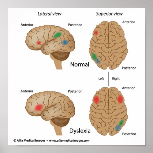 Dyslexia brain activity Poster