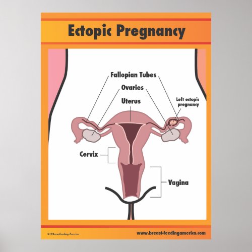 Ectopic Pregnancy Poster