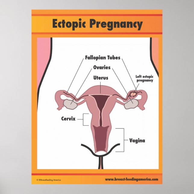 Ectopic Pregnancy Poster (Front)
