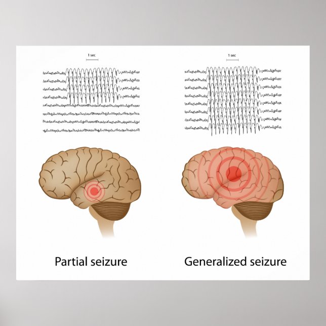 EEG in partial and generalized epilepsy Poster (Front)