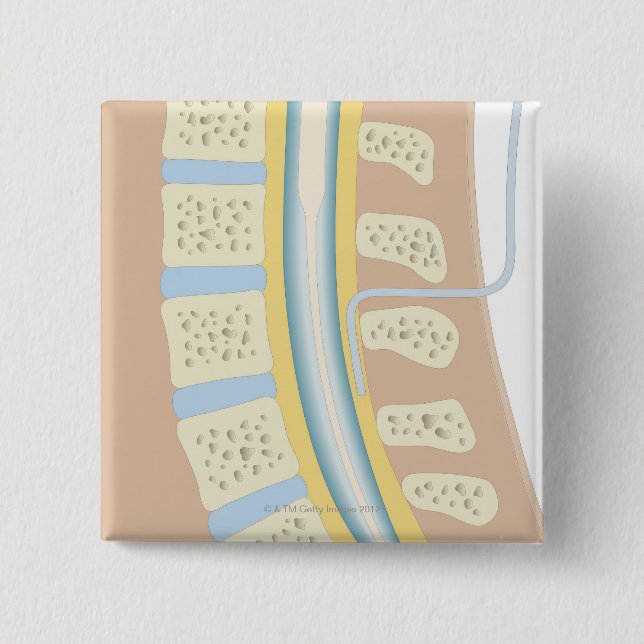 Epidural Anaesthesia Button (Front)