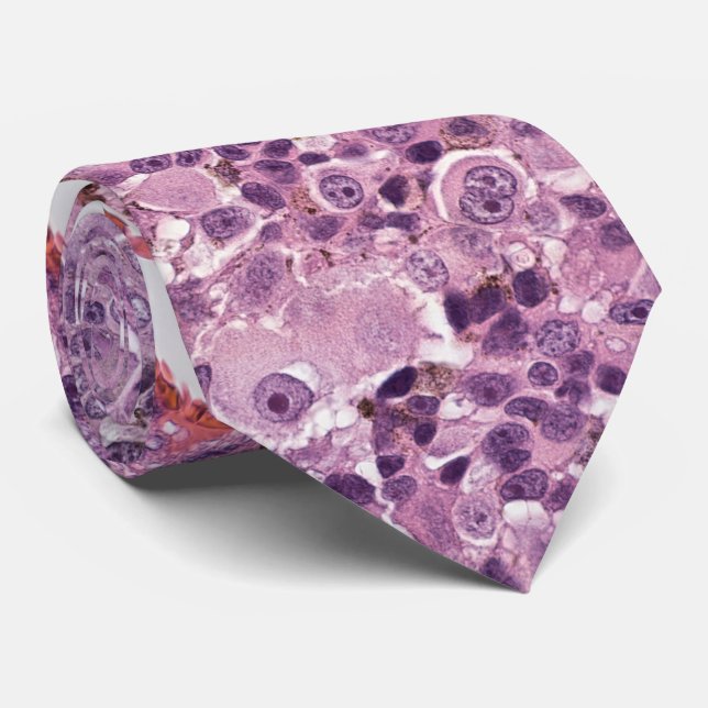 Epithelioid uveal melanoma neck tie (Rolled)