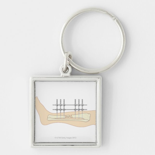 External Fixator Keychain (Front)