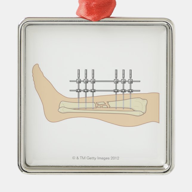 External Fixator Metal Ornament (Front)