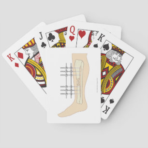 External Fixator Poker Cards