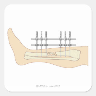 External Fixator Square Sticker
