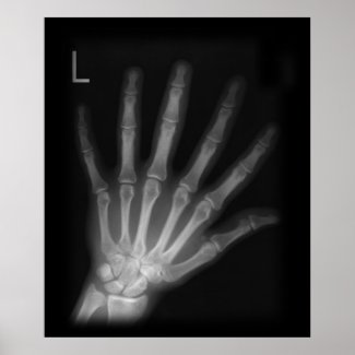 Extra Digit X-ray Left Hand Poster