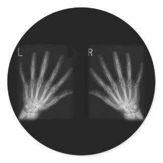 Extra Digit X-ray Right & Left Hands Classic Round Sticker