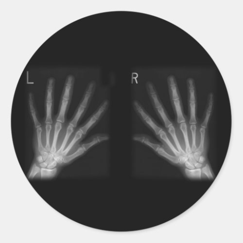 Extra Digit X_ray Right  Left Hands Classic Round Sticker