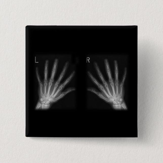 Extra Digit X-ray Right & Left Hands Pinback Button (Front)