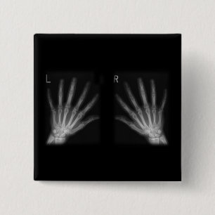 Extra Digit X-ray Right & Left Hands Pinback Button