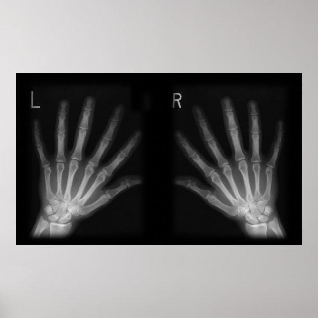 Extra Digit X-ray Right & Left Hands Poster (Front)