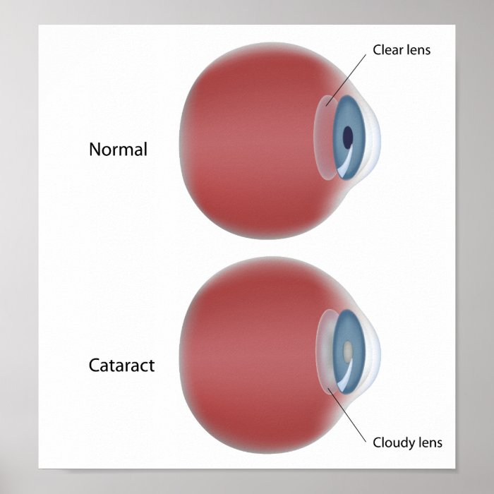 Eye disease cataract   Poster