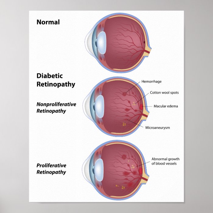 Eye disease Diabetic retinopathy Poster