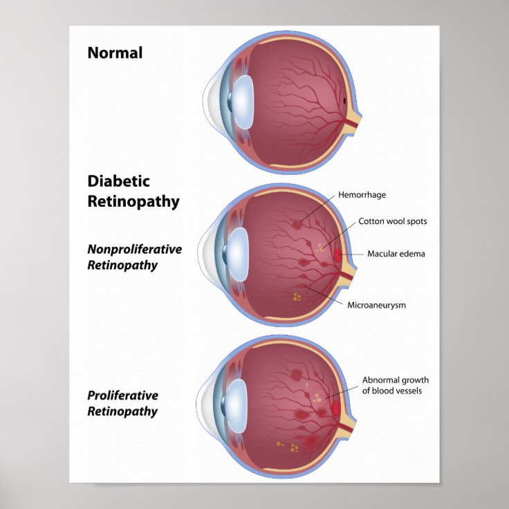 Eye disease Diabetic retinopathy Poster | Zazzle