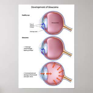 Eye Disease Glaucoma Poster