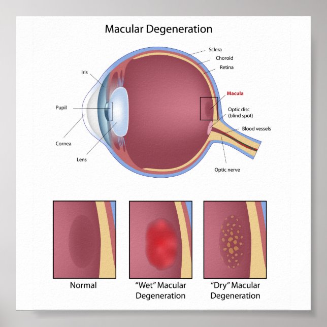 Eye macular degeneration Poster (Front)