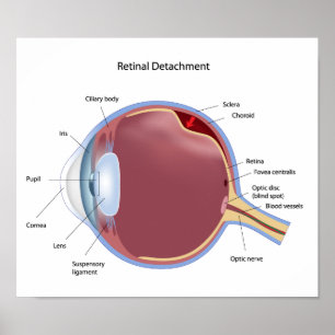 Eye retinal detachment Poster