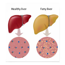 Fatty liver disease Poster