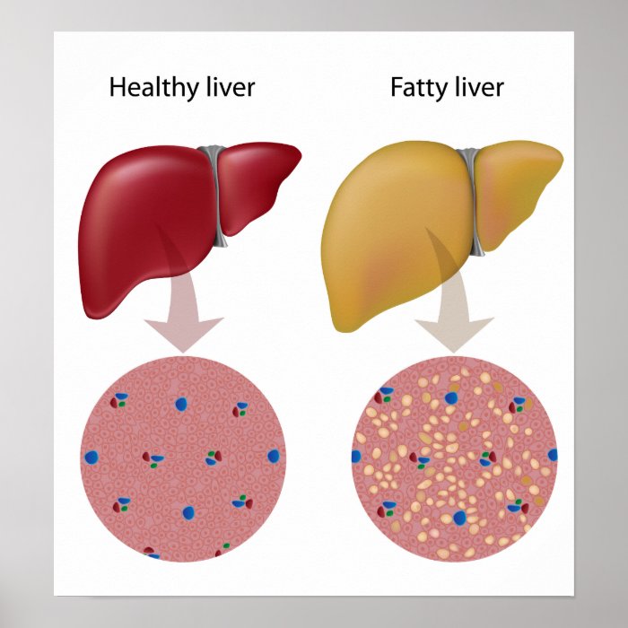 Fatty liver disease Poster