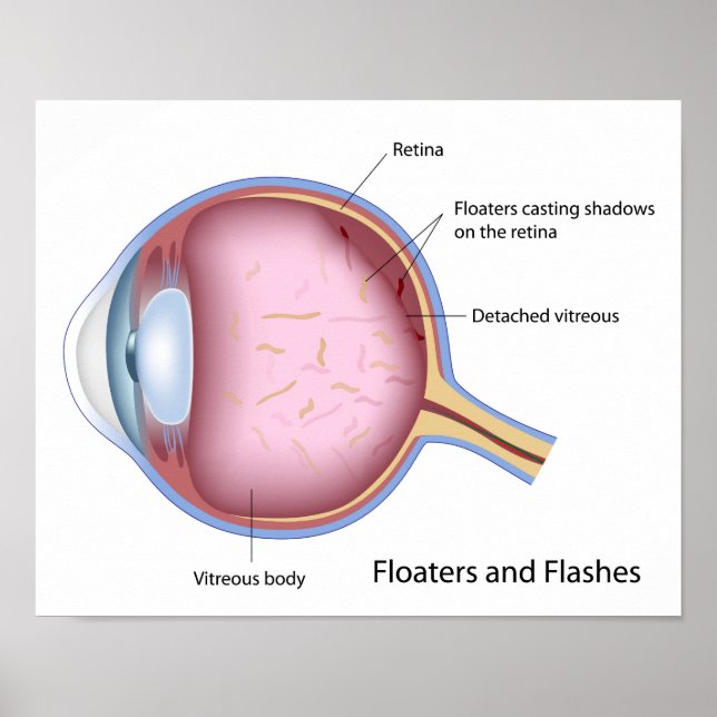 Floaters and Flashes eye disease Poster (Front)