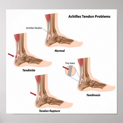 Foot pain Achilles tendon problems Poster