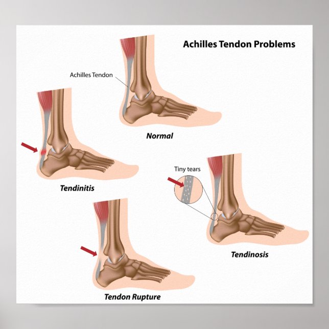 Foot pain Achilles tendon problems Poster (Front)