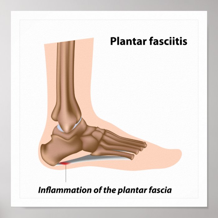 Foot problem Plantar fasciitis Poster