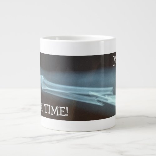 Fractured Radius and Ulna Xray Break Time Giant Coffee Mug