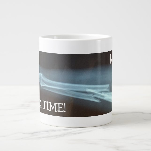 Fractured Radius and Ulna Xray "Break Time" Giant Coffee Mug (Front)