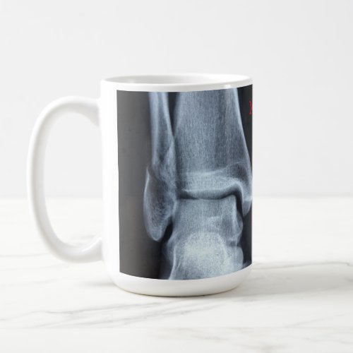 Funny Broken Fibula Xray Break Time   Coffee Mug