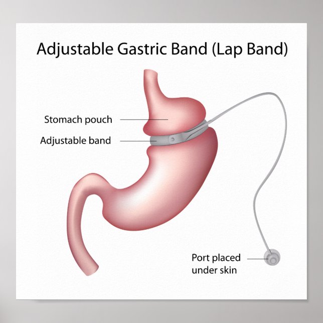 Gastric Band Weight Loss Surgery  Poster (Front)