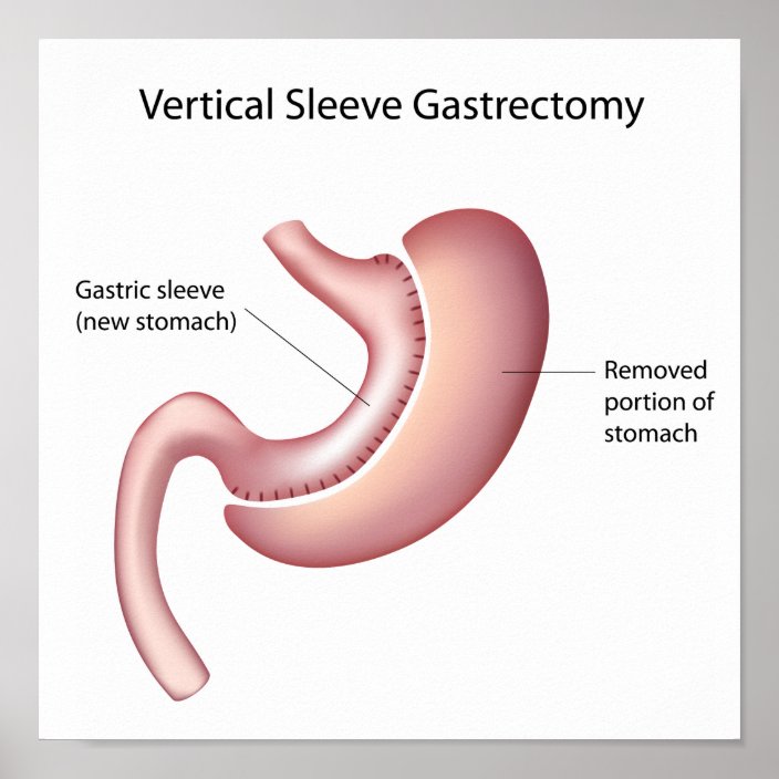 Gastric sleeve weight loss surgery Poster | Zazzle.com