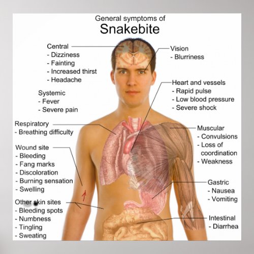 General Symtoms Chart of a Snakebite Poisoning