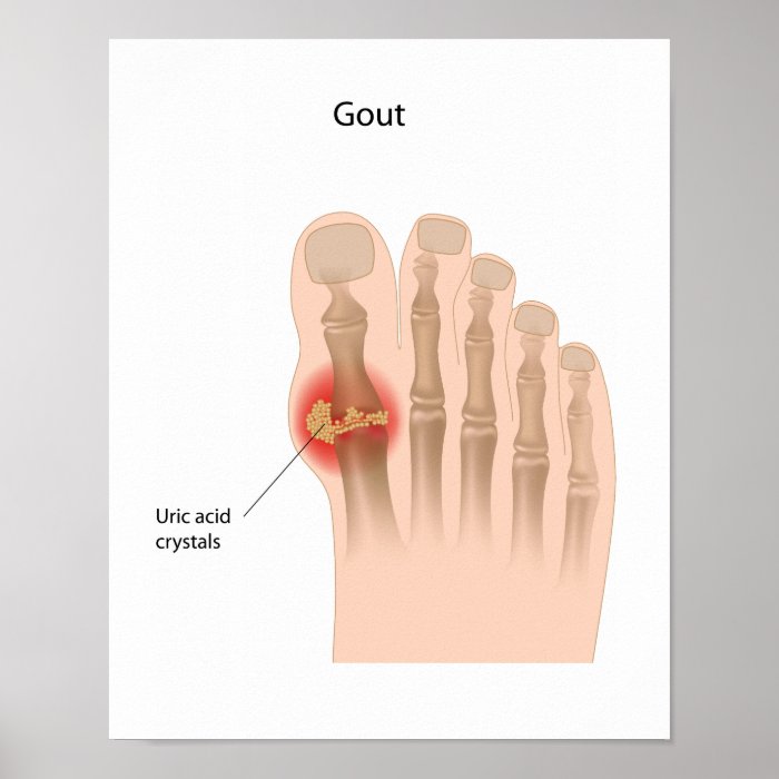 Gout of the big toe Poster