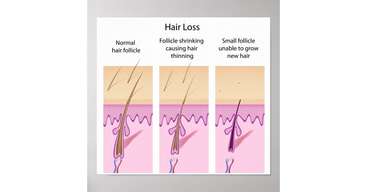 Hair loss process Poster | Zazzle