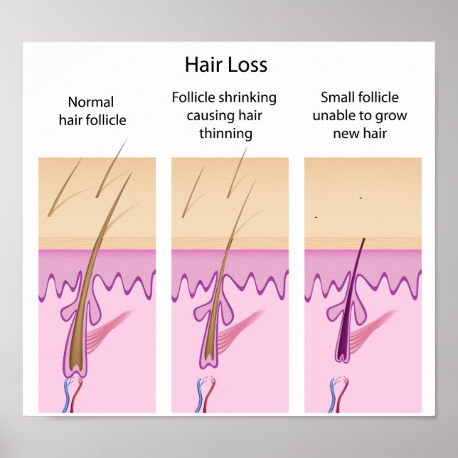 Hair loss process Poster (Front)