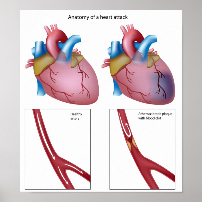 Heart attack Poster