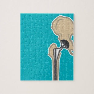 Hip Joint Replacement Jigsaw Puzzle