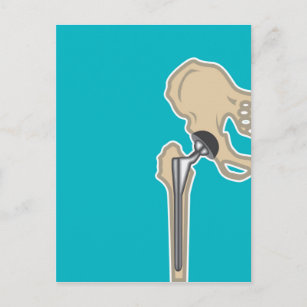 https://rlv.zcache.com/hip_joint_replacement_postcard-rd76b5fe3c6d54d67bdd635fd60975d7c_ucbjp_307.jpg