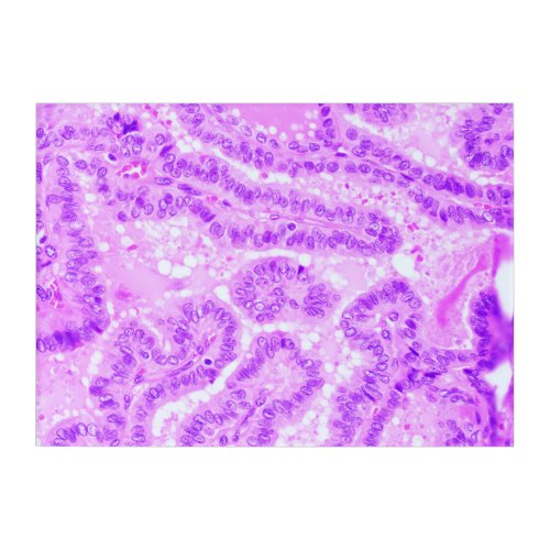 Histology Art _ Papillary Thyroid Carcinoma