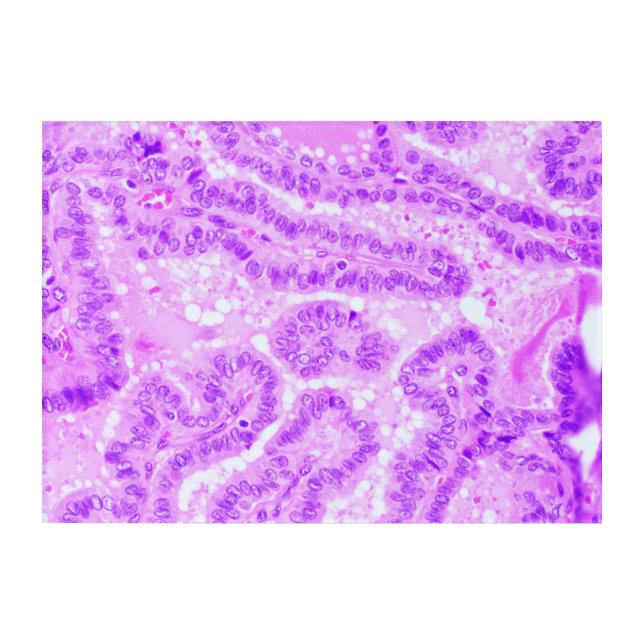 Histology Art - Papillary Thyroid Carcinoma (Front)