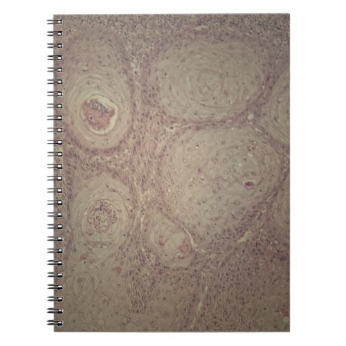 Human skin with squamous cell carcinoma notebook