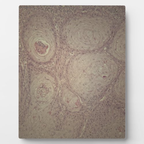 Human skin with squamous cell carcinoma plaque