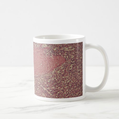 Human spleen with chronic myelogenous leukemia coffee mug